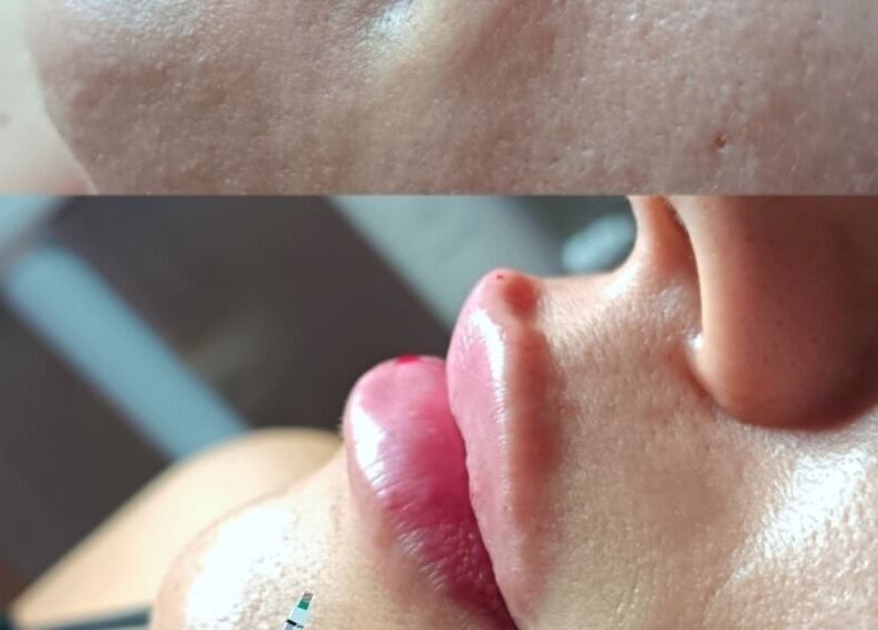 Прецизна контуризация на устни в студио Baeuty&Aesthetic Astyle, Кирчево, Ловеч, BG, преди и след.