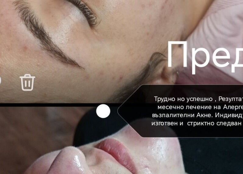 Преди и след лечение на акне в Baeuty&Aesthetic studio Astyle, Кирчево, Ловеч, BG.