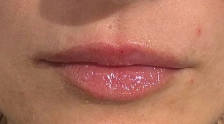 Close-up of glossy lips at InStudio Aesthetics, enhancing beauty in London, England, GB.