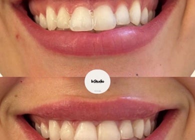Before and after smile enhancement at InStudio Aesthetics, London, England, GB. Visible improvement in whiteness.