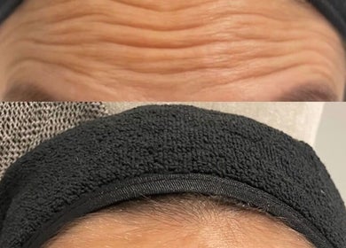Before and after forehead wrinkle treatment at InStudio Aesthetics, London, England, GB.