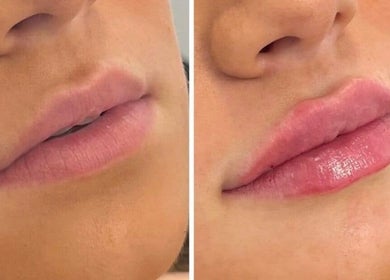 Before and after lip enhancement at InStudio Aesthetics, London, England, GB showing fuller lip results.