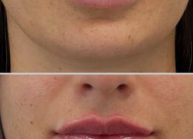 Before and after lip enhancement at InStudio Aesthetics, London, England, GB showing enhanced lip volume.