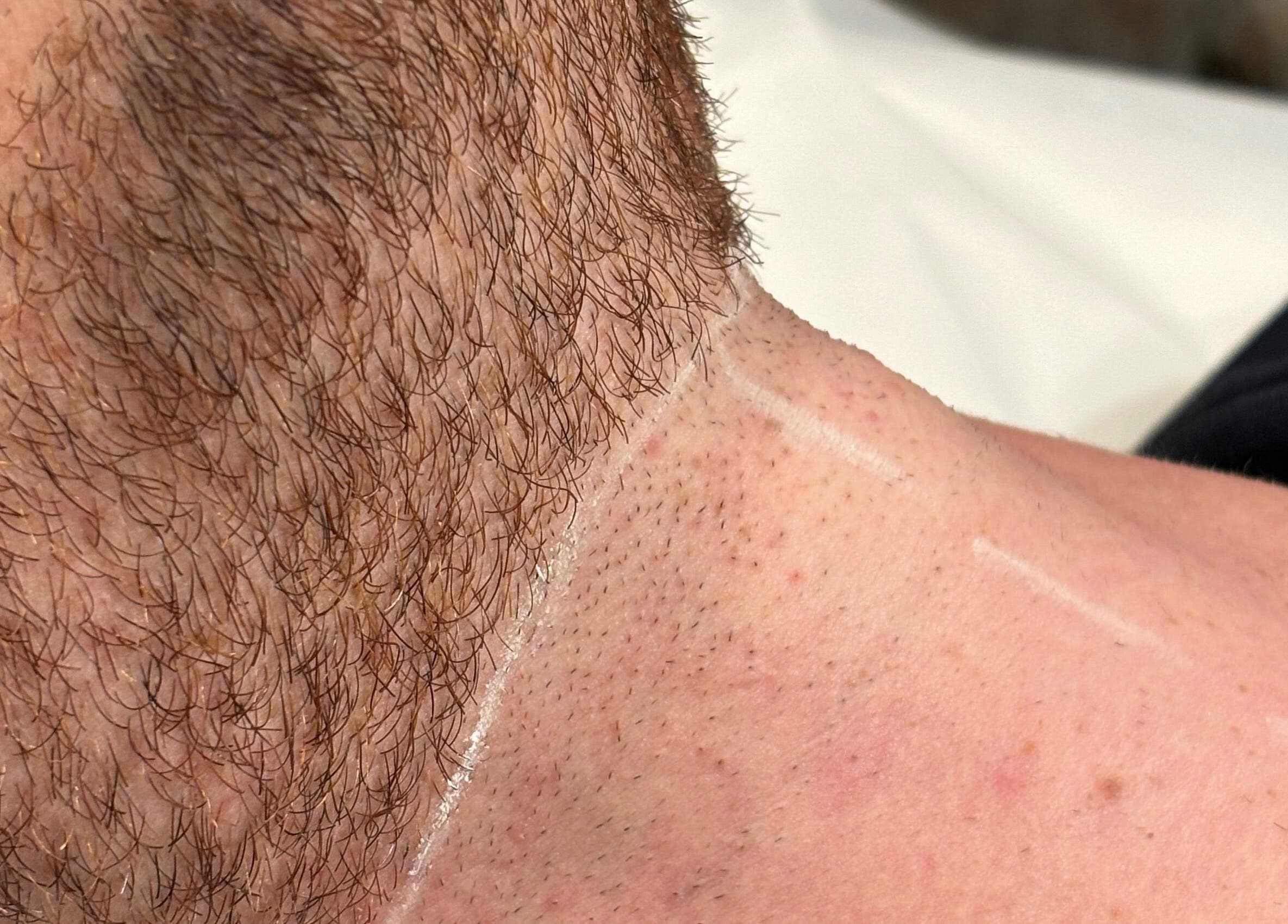 Service de contour de barbe chez ELORA Laser, Laval, Québec, CA. Peau soignée et précise.