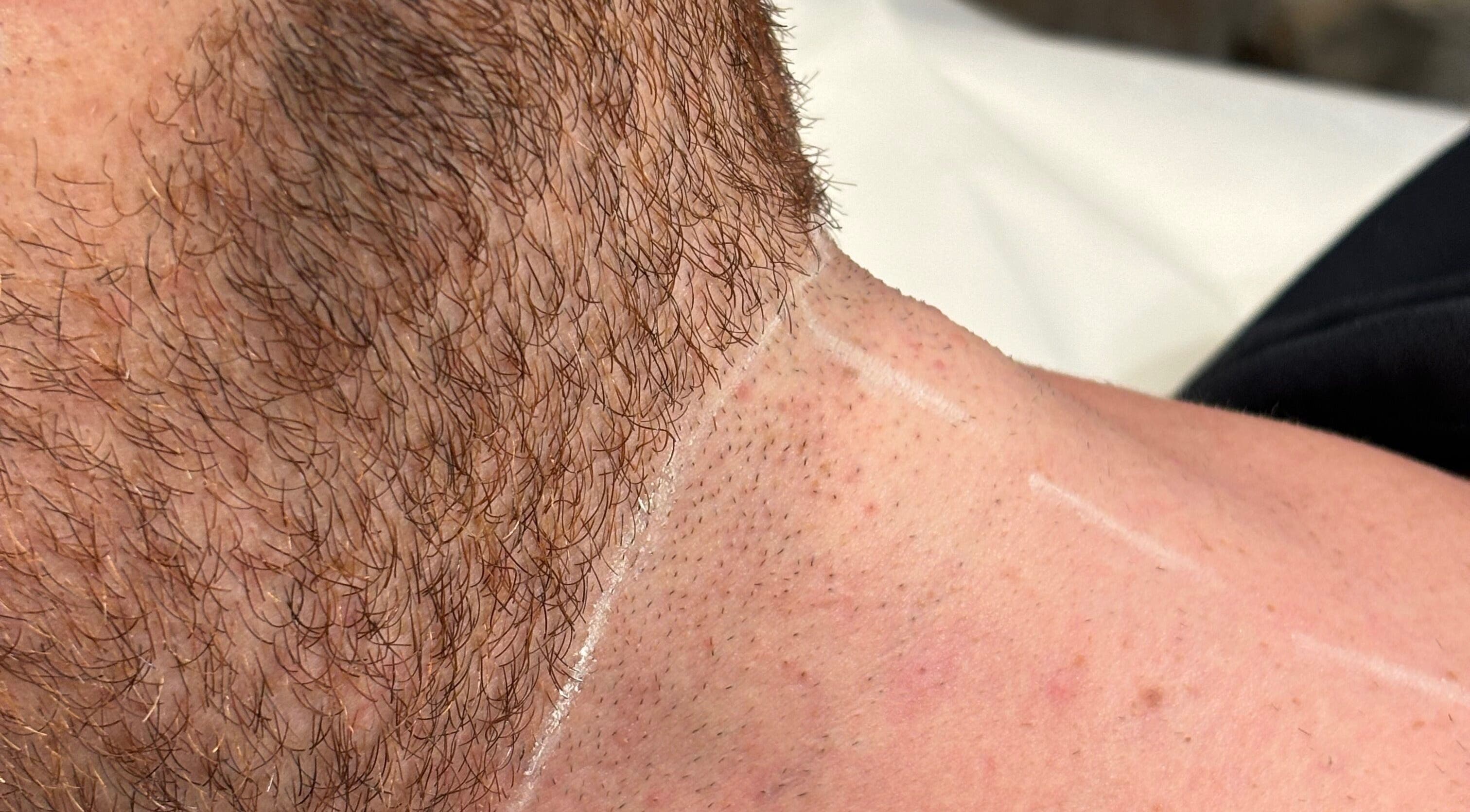 Service de contour de barbe chez ELORA Laser, Laval, Québec, CA. Peau soignée et précise.