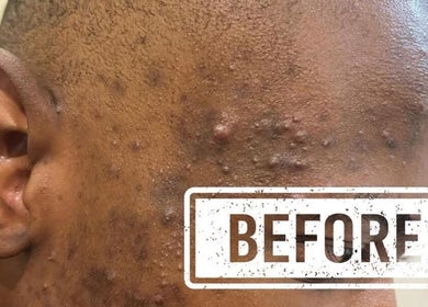 Close-up of acne treatment at First Aesthetics Bw, Gaborone, Gaborone City, BW.