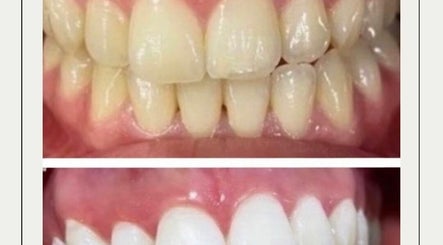 SmileBright Teeth Whitening 2paveikslėlis