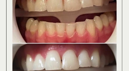 SmileBright Teeth Whitening 3paveikslėlis