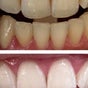 Smile Bright Teeth Whitening - 3A Ngahere Street, Fendalton, Christchurch, Canterbury