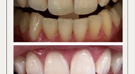 Smile Bright Teeth Whitening