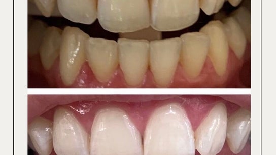 Smile Bright Teeth Whitening