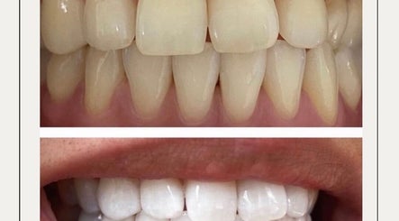 Smile Bright Teeth Whitening 2paveikslėlis