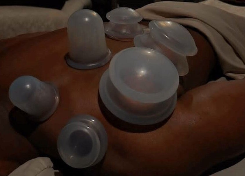 Cupping therapy on a back at James Joseph L.M.T, Houston, Texas, US, enhancing relaxation and wellness.