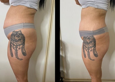 Before and after body treatment at Level Up Success, Helensvale, Queensland, AU showing visible improvement.