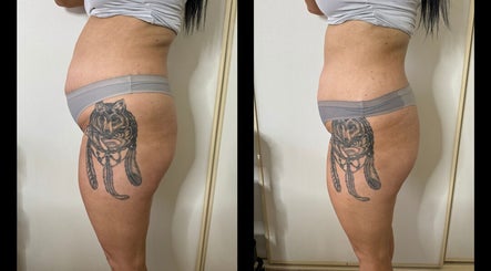 Before and after body treatment at Level Up Success, Helensvale, Queensland, AU showing visible improvement.