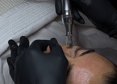 Microneedling facial at Nataly Evo, Cannes, Provence-alpes-côte D'azur, FR for youthful skin.