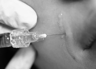 Injectable treatment at Nataly Evo in Cannes, Provence-alpes-côte D'azur, FR, highlighting facial rejuvenation.