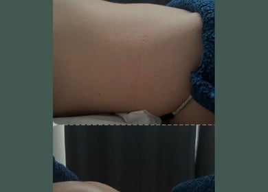 Before and after skin treatment at Self Care Holistics and Therapies, Liverpool, England, GB.