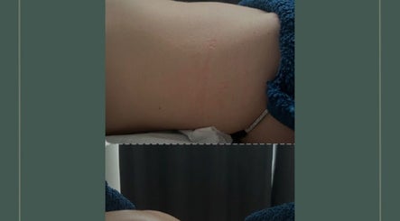 Before and after skin treatment at Self Care Holistics and Therapies, Liverpool, England, GB.