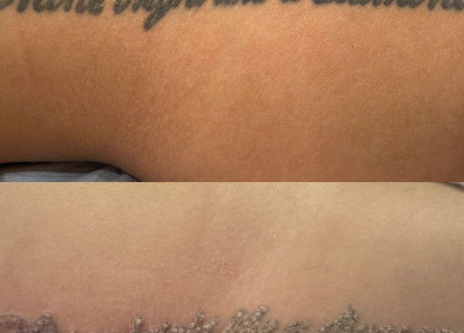 Before and after tattoo removal at Radiance Laser Studio, Aberdeen, Scotland, GB showcasing clear skin.