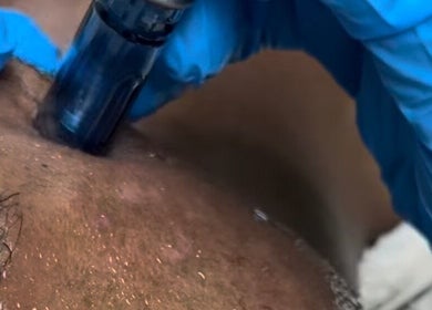 HydraFacial skin treatment at JustGridzSkins, Pretoria, Gauteng, ZA, promotes hydration and rejuvenation.