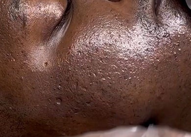 Close-up skin texture highlighting treatment at JustGridzSkins, Pretoria, Gauteng, ZA.