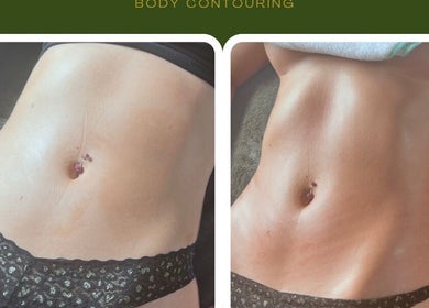 Before and after body contouring at M Sculpt, Southampton, England, GB showcasing visible sculpting results.