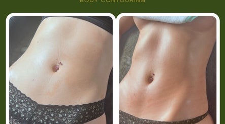 Before and after body contouring at M Sculpt, Southampton, England, GB showcasing visible sculpting results.