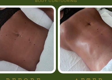 Before and after body contouring treatment at M Sculpt, Southampton, England, GB showcasing skin smoothness.