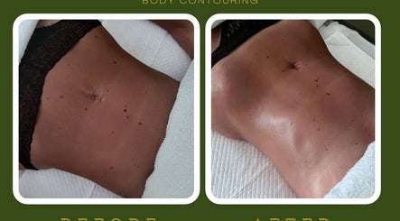 Before and after body contouring treatment at M Sculpt, Southampton, England, GB showcasing skin smoothness.