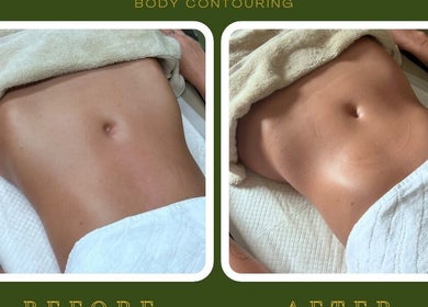 Before and after body contouring at M Sculpt, Southampton, England, GB showcasing noticeable waist reduction.