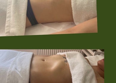 Body contouring treatment at M Sculpt in Southampton, England, GB showing before and after results.