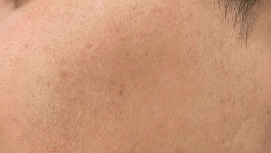 Close-up of smooth skin after treatment at Sara Raquel Beauty, Navan, County Meath, IE.