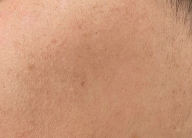 Close-up of smooth skin after treatment at Sara Raquel Beauty, Navan, County Meath, IE.