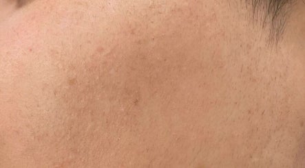 Close-up of smooth skin after treatment at Sara Raquel Beauty, Navan, County Meath, IE.