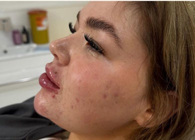 Close-up of a woman post-treatment at RYNAESTHETICS - Nurse Aesthetics, Glasgow, Scotland, GB.