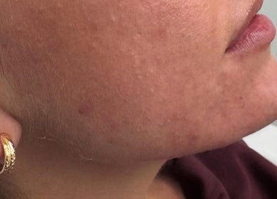 Close-up of facial skin treatment at RYNAESTHETICS - Nurse Aesthetics in Glasgow, Scotland, GB.