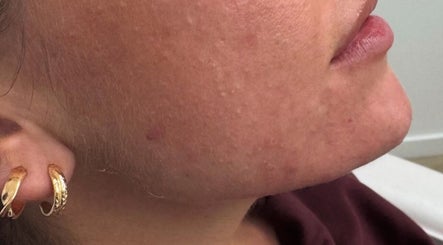 Close-up of facial skin treatment at RYNAESTHETICS - Nurse Aesthetics in Glasgow, Scotland, GB.