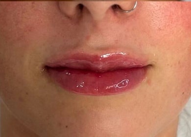 Close-up of glossy lips enhancement at RYNAESTHETICS - Nurse Aesthetics. Located in Glasgow, Scotland, GB.
