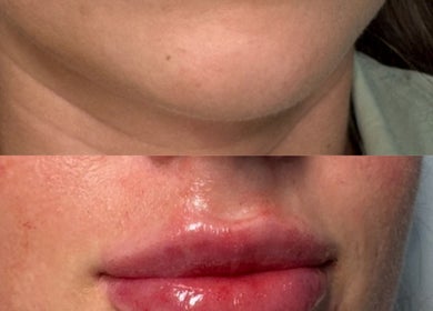 Before and after lip enhancement at RYNAESTHETICS - Nurse Aesthetics in Glasgow, Scotland, GB.