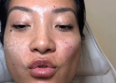 Close-up of a facial treatment at AESTHETICS. By Nurse Ryan, Glasgow, Scotland, GB.