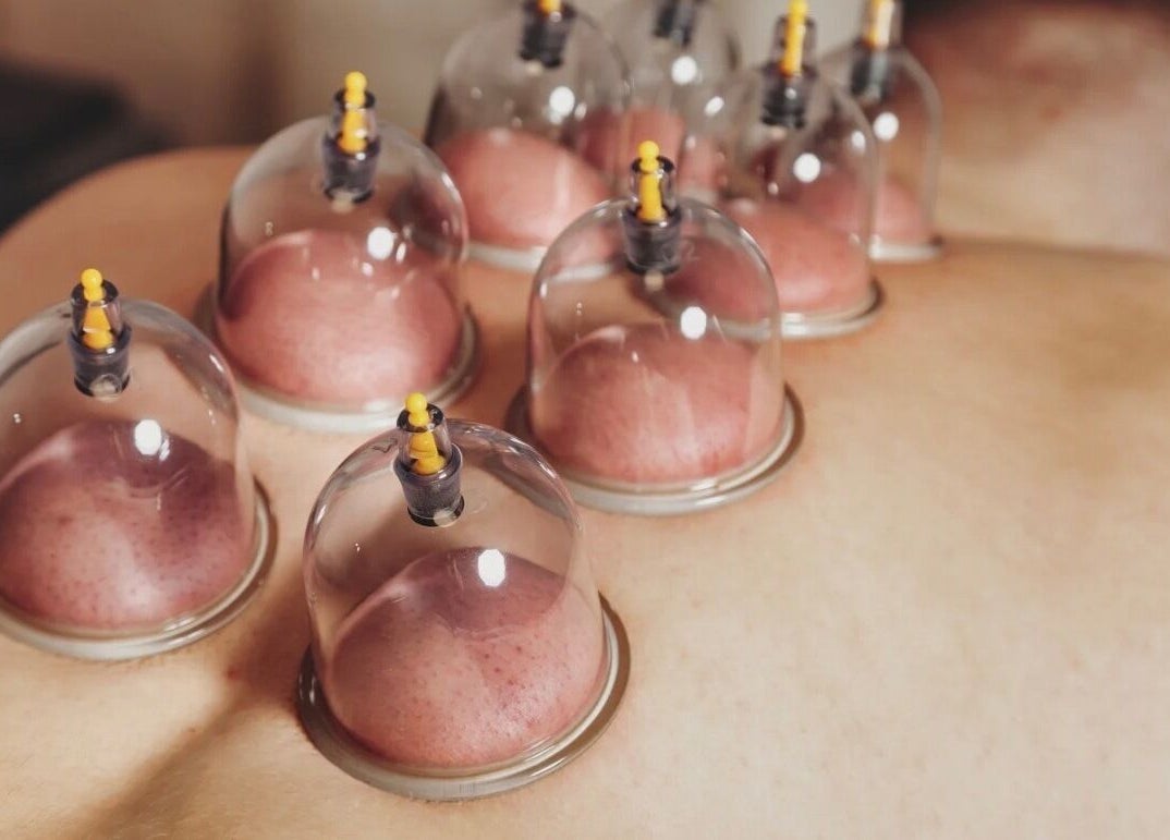 Relaxation therapy at Shellharbour Village Thai Massage in Shellharbour, New South Wales, AU, featuring cupping.