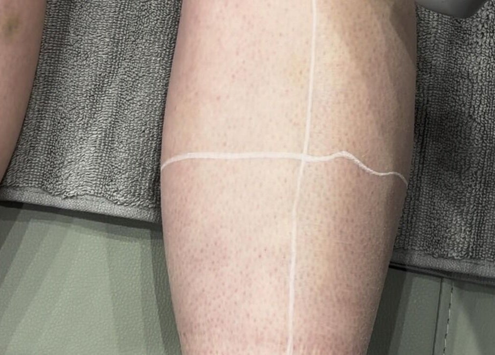 Leg receiving a skincare treatment at TMC Lifestyle & Aesthetics, Wagga Wagga, New South Wales, AU.