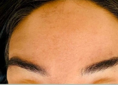 Close-up of smooth forehead after treatment at Abi Peters Aesthetics (Denmead), Denmead, England, GB.