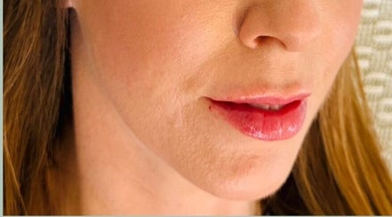 Closeup of enhanced lips at Abi Peters Aesthetics (Bedhampton), Bedhampton, United Kingdom, GB.