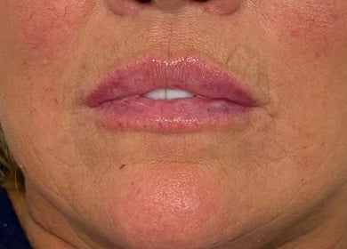 Close-up of enhanced lips at Youthful You, Barnstaple, England, GB showcasing lip treatment results.