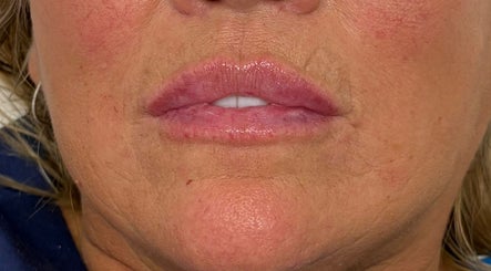 Close-up of enhanced lips at Youthful You, Barnstaple, England, GB showcasing lip treatment results.