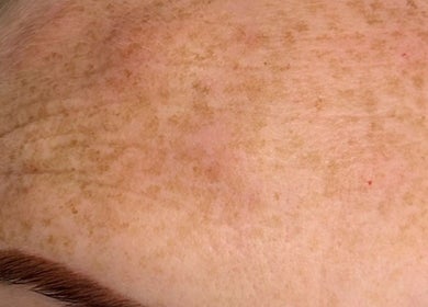 Close-up of skin pigmentation treatment at Youthful You, Barnstaple, England, GB.