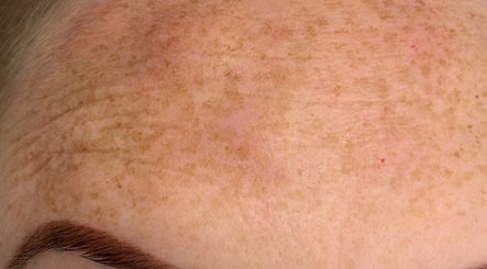Close-up of skin pigmentation treatment at Youthful You, Barnstaple, England, GB.