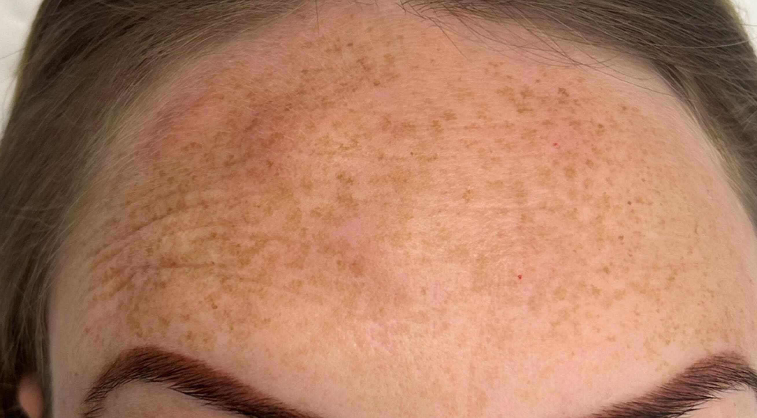 Close-up of a forehead with freckles at Skins Devon, Barnstaple, England, GB, highlighting skin texture.